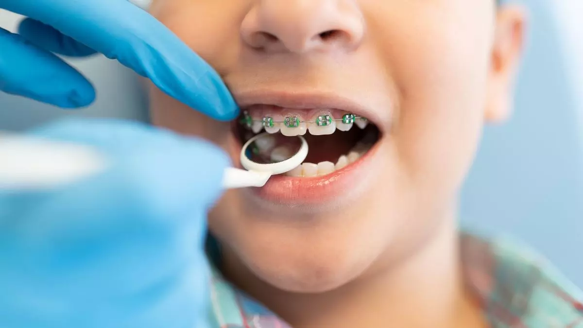 Qual è l’età giusta per mettere l’apparecchio ai denti?