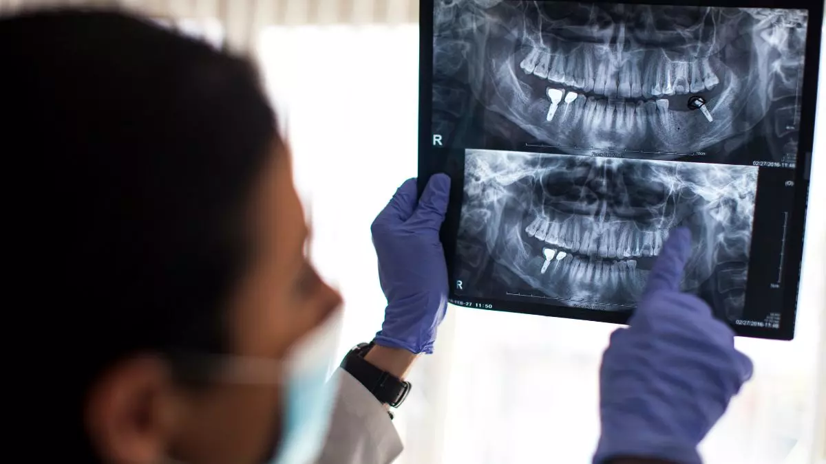 Quanti impianti dentali si possono fare in una seduta?