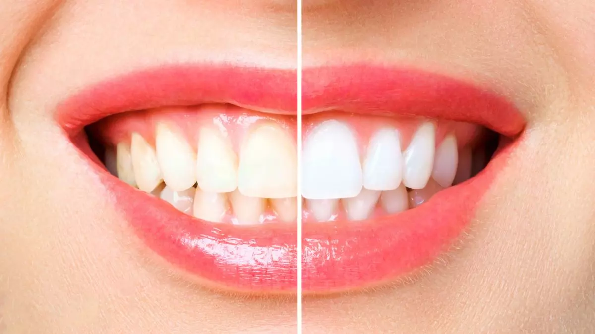 Risultato sbiancamento dentale professionale