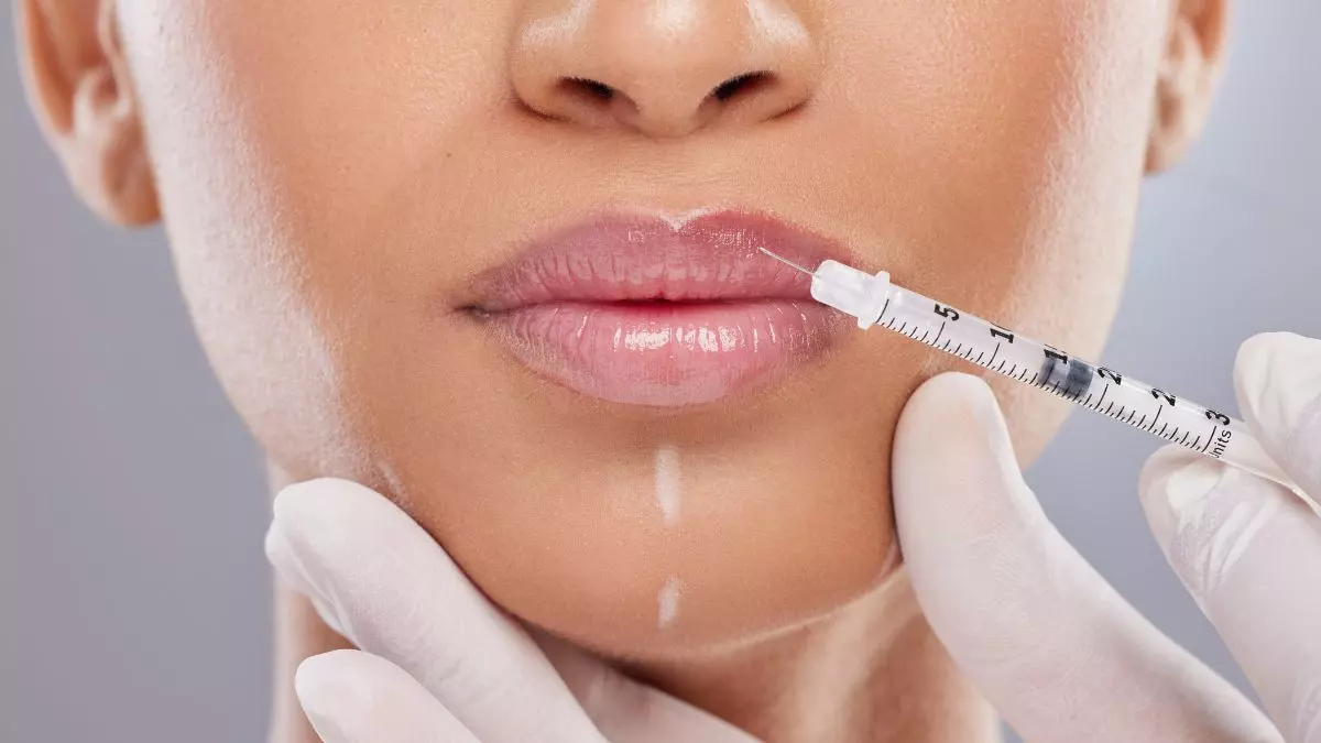 Open Day Medicina Estetica Dental Genesis Filler Labbra